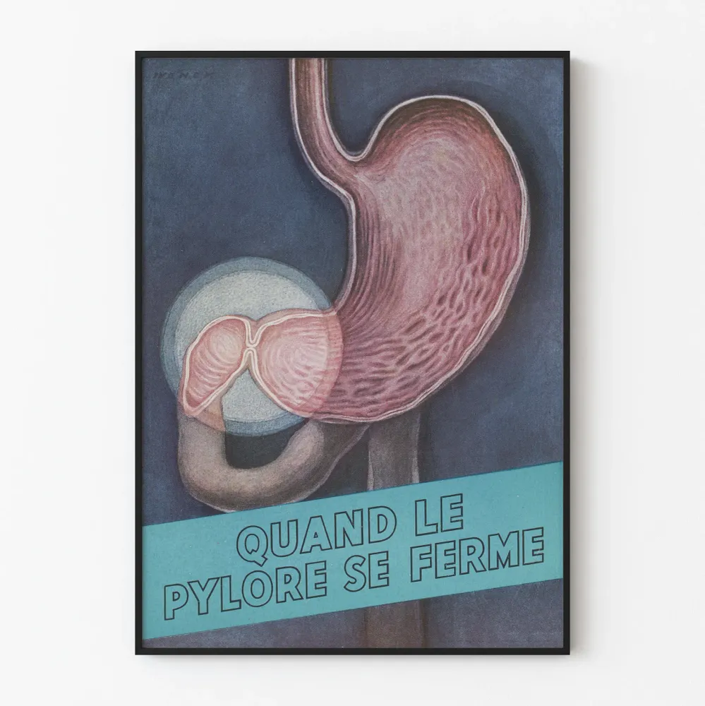 Affiche Anatomique Pylore et Estomac - Décoration Murale Médicale
