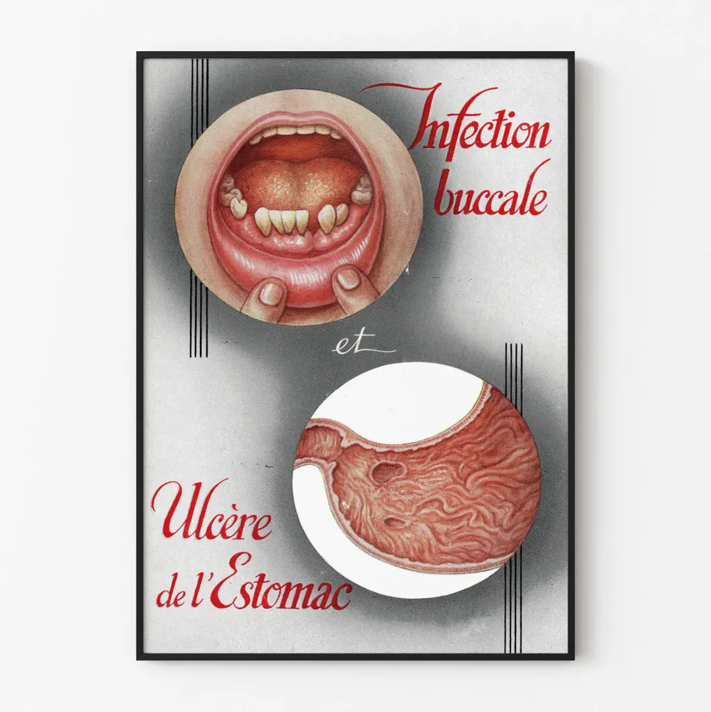 Affiche médicale vintage infection buccale et ulcère de l'estomac